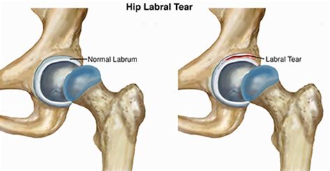 acetabular labral tear special tests|acetabular labral calcification radiology.